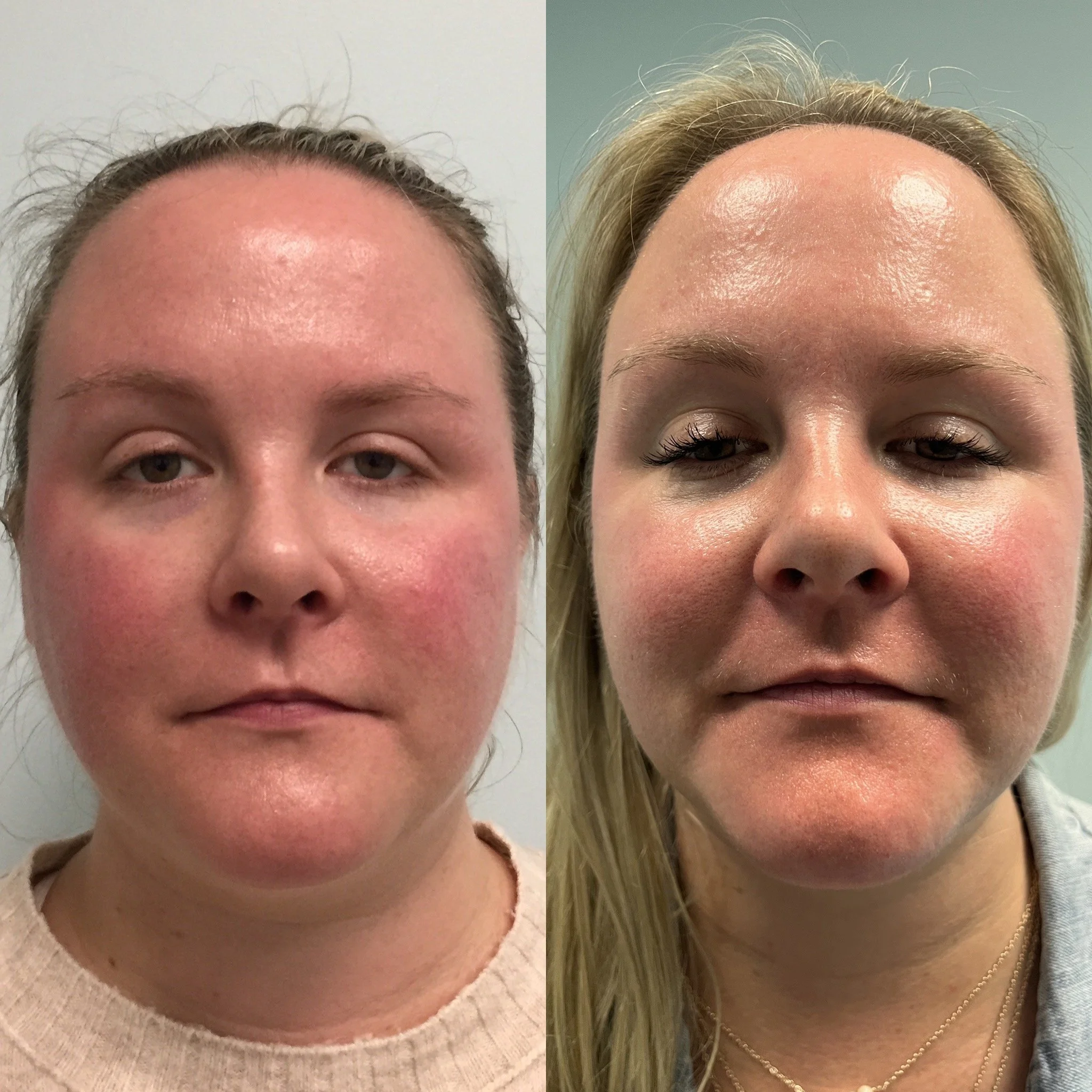 Laser Treatments — Advanced Dermatology & Aesthetic Medicine